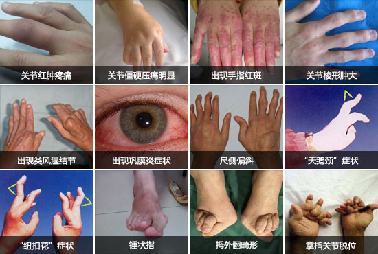 成都风湿医院类风湿不及时治疗造成的危害.jpg